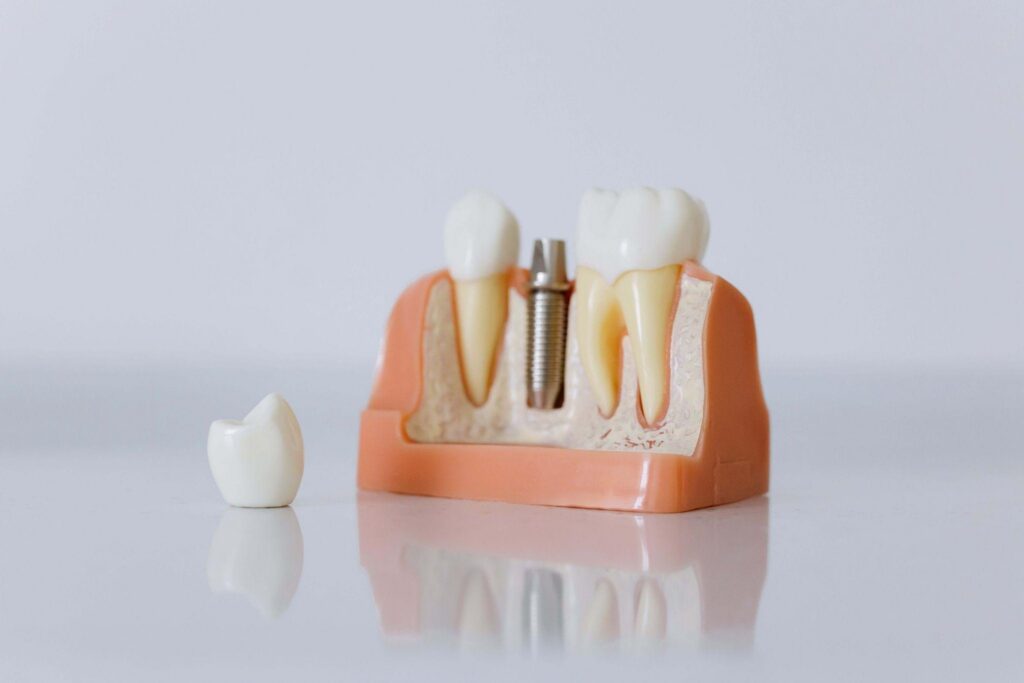 Dental Implants at Al Care Dental in Leduc