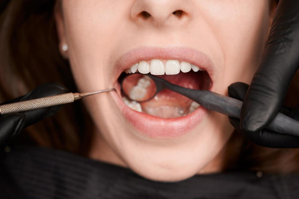 Invisalign Clear Aligners at Al Care Dental in Leduc