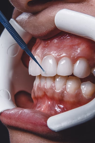 A dentist working on the upper front teeth
