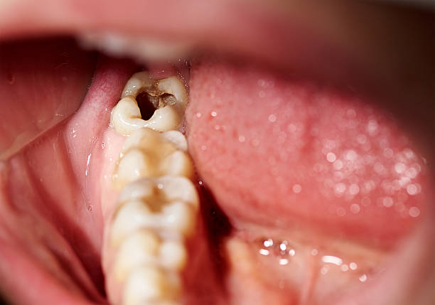 A close-up of an open mouth showing a damaged tooth