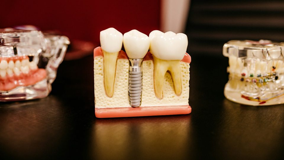A dental implant model showing the implant and crown