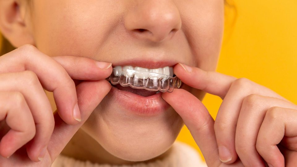 A clear plastic aligner being fitted over the teeth