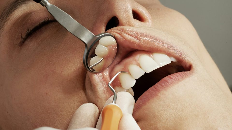 Dental cleaning — a mirror and scaler checking the teeth